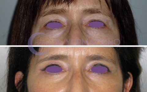 Blepharoplasty – Case 1/A