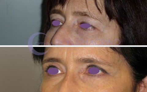 Blepharoplasty – Case 1/B