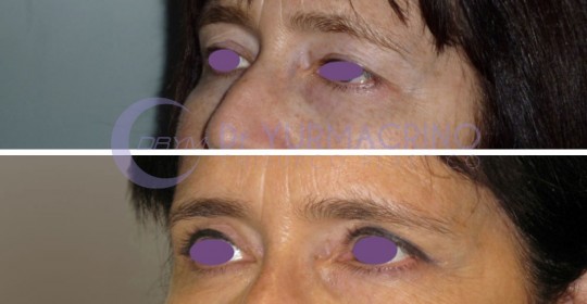 Blepharoplasty – Case 1/B