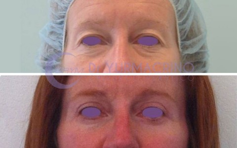 Blepharoplasty – Case 2/A