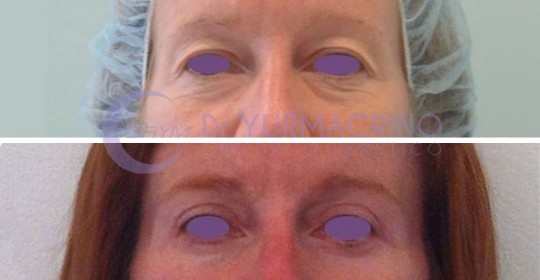 Blepharoplasty – Case 2/A