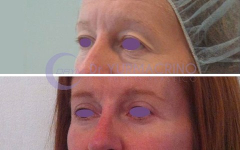 Blepharoplasty – Case 2/B