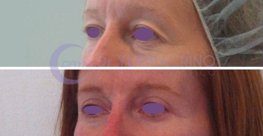 Blepharoplasty – Case 2/B