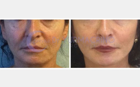 Face Lifting – Case 1/A