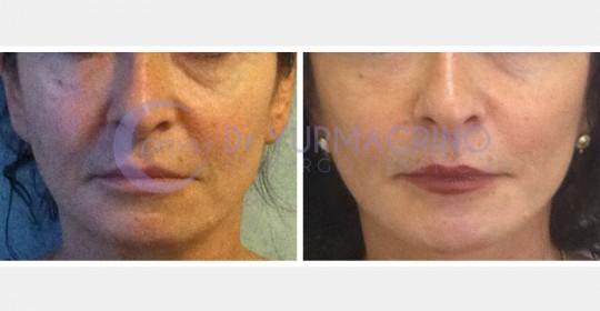 Face Lifting – Case 1/A