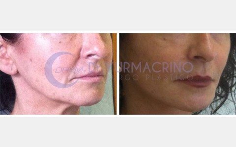 Face Lifting – Case 1/B