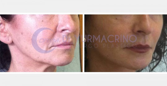 Face Lifting – Case 1/B