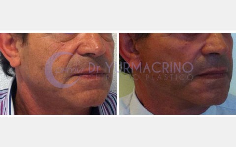 Face Lifting – Case 2/A