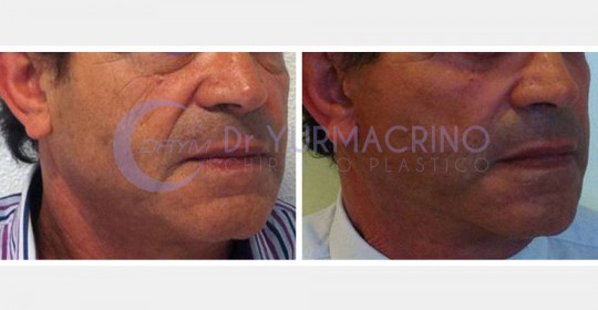 Face Lifting – Case 2/A