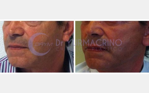 Face Lifting – Case 2/B