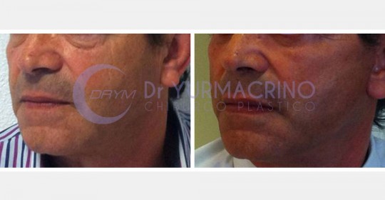 Face Lifting – Case 2/B