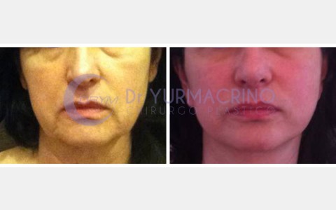 Face Lifting – Case 3/A