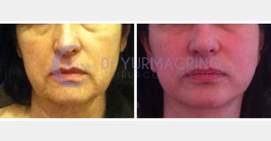 Face Lifting – Case 3/A