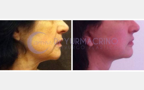 Face Lifting – Case 3/B