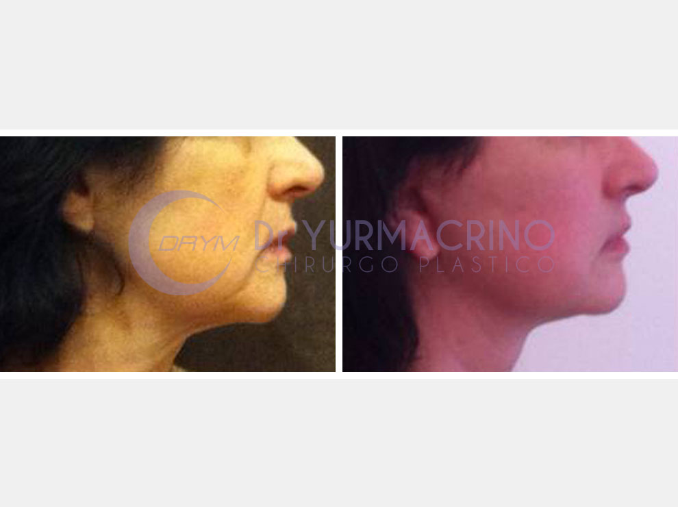 Lifting facial - Doctor Pumarino