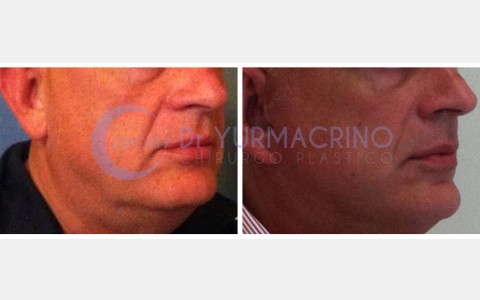 Face Lifting – Case 5/A