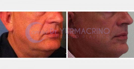 Face Lifting – Case 5/A