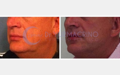 Face Lifting – Case 5/B