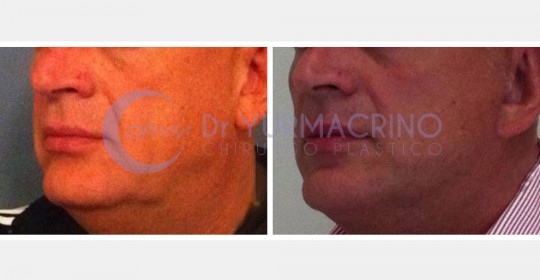 Face Lifting – Case 5/B