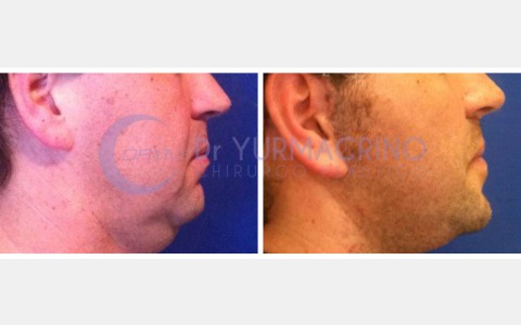 Face Lifting – Case 6