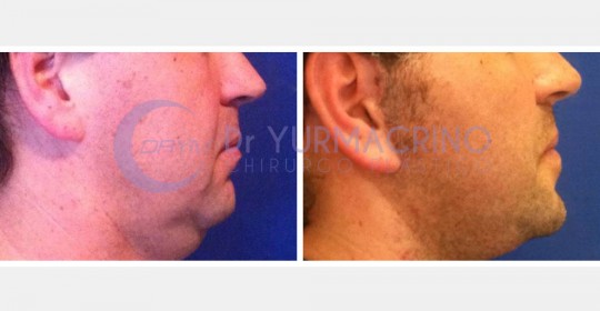 Face Lifting – Case 6