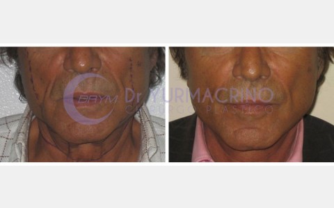 Face Lifting – Case 7/A