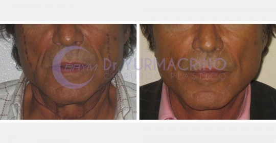 Face Lifting – Case 7/A