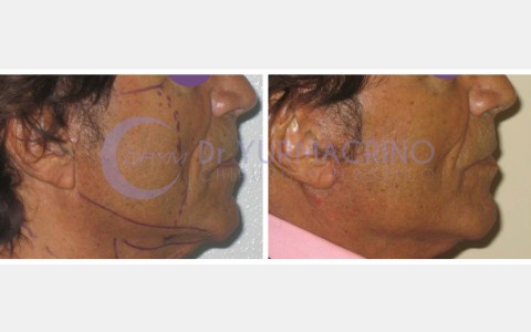 Face Lifting – Case 7/B