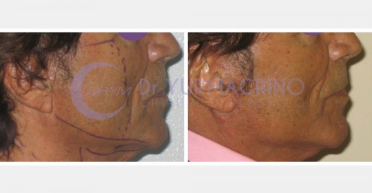 Face Lifting – Case 7/B