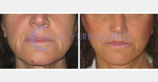 Face Lifting – Case 8/A