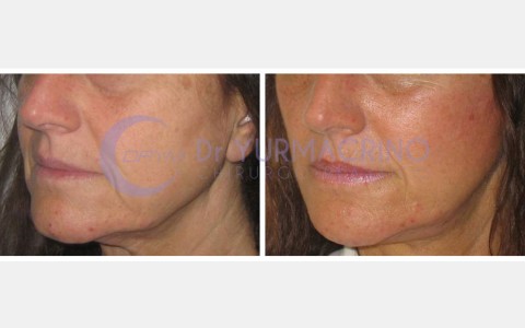 Face Lifting – Case 8/B