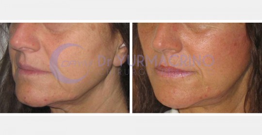 Face Lifting – Case 8/B