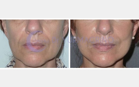 Face Lifting – Case 9/A