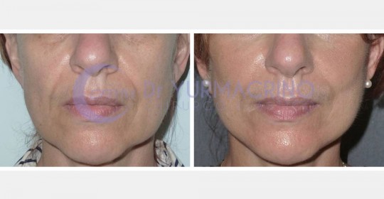 Face Lifting – Case 9/A