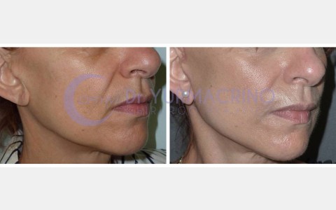 Face Lifting – Case 9/B