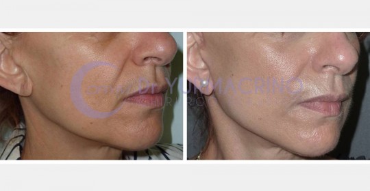 Face Lifting – Case 9/B