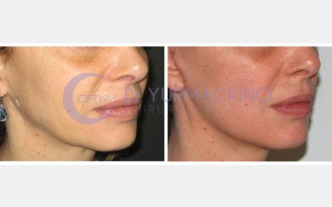 Face Lifting – Case 10