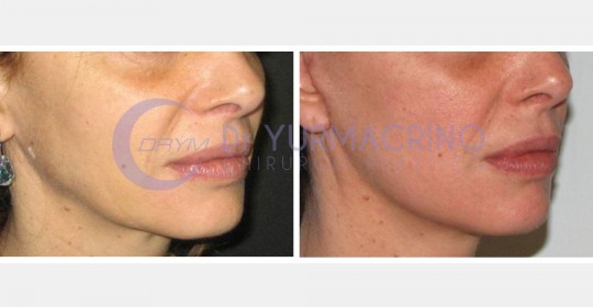 Face Lifting – Case 10