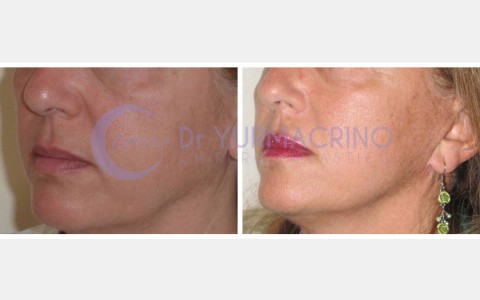 Face Lifting – Case 11