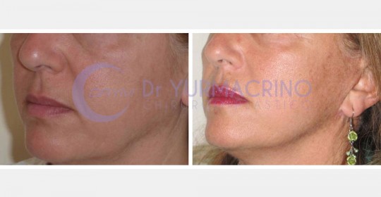 Face Lifting – Case 11