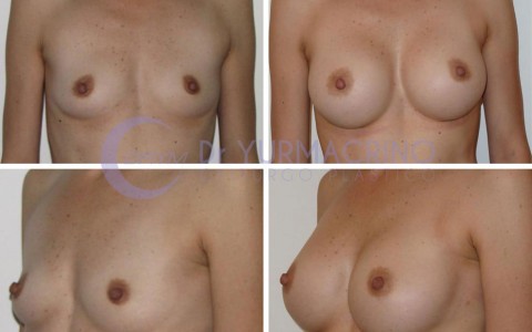 Breast Augmentation – Case 1