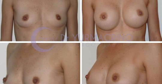 Breast Augmentation – Case 1