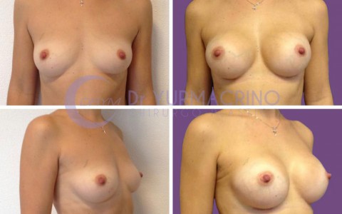 Breast Augmentation – Case 2