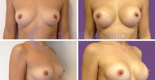 Breast Augmentation – Case 2