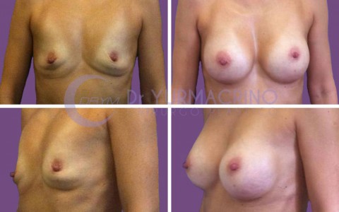 Breast Augmentation – Case 3