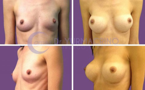 Breast Augmentation – Case 4