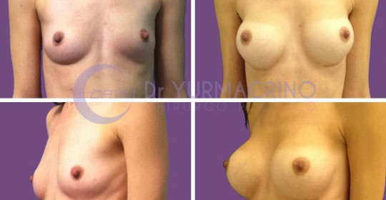 Breast Augmentation – Case 4