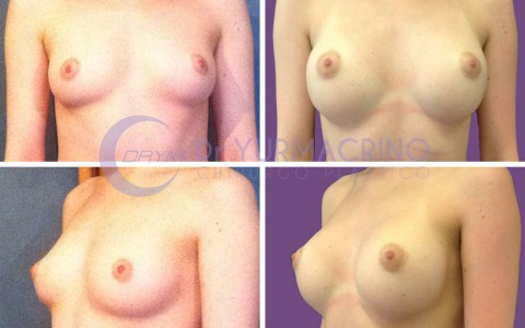 Breast Augmentation – Case 5