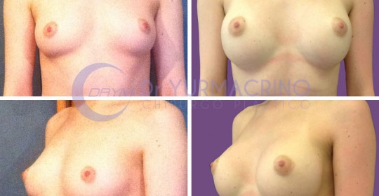 Breast Augmentation – Case 5