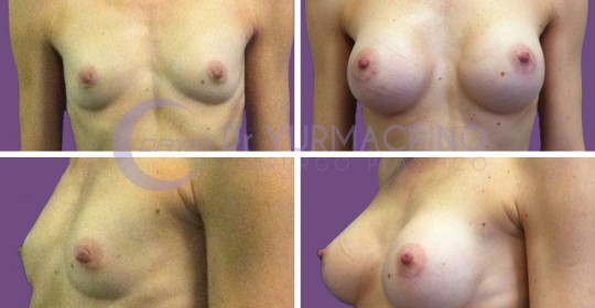 Breast Augmentation – Case 6